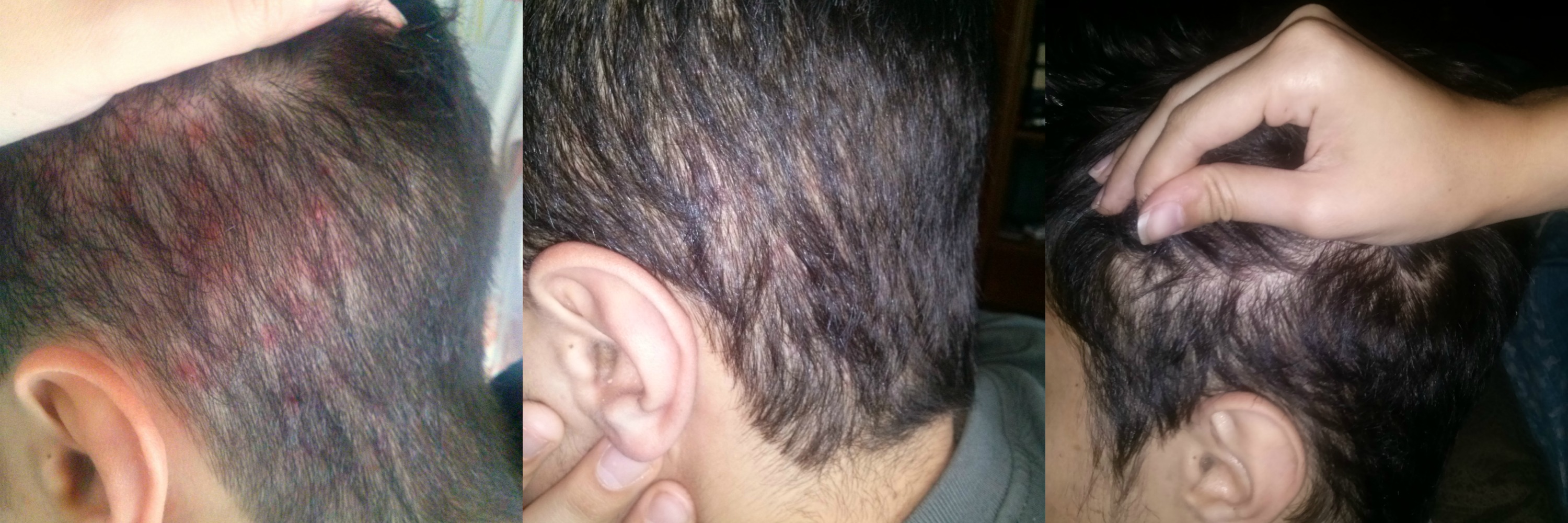 Seb Dermatitis Gone In 4 Weeks With TLC Naturals Scalp Therapy